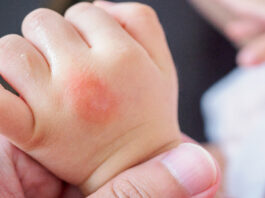 benadryl dosage for kids