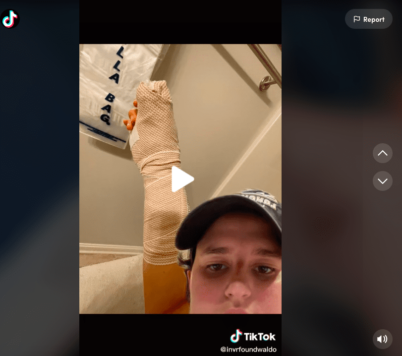 Screenshot of TikTok creator's hand in bandages after cancer surgery to remove tissue and bone from thumb nail bed. 