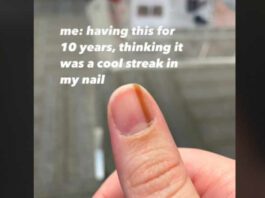screenshot of close up of thumb with brown streak on nail
