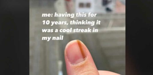 screenshot of close up of thumb with brown streak on nail