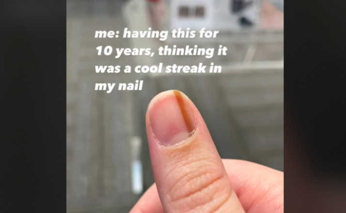 screenshot of close up of thumb with brown streak on nail