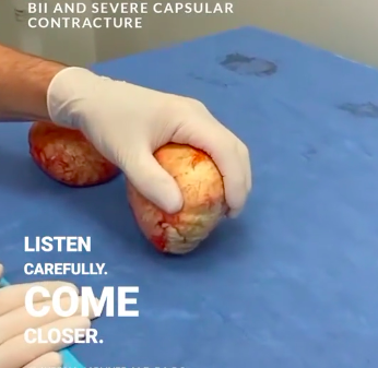 Screenshot from TikTok showing a calcified breast implant.