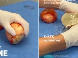 screenshots of TikTok video of doctor cracking open calcified breast implants