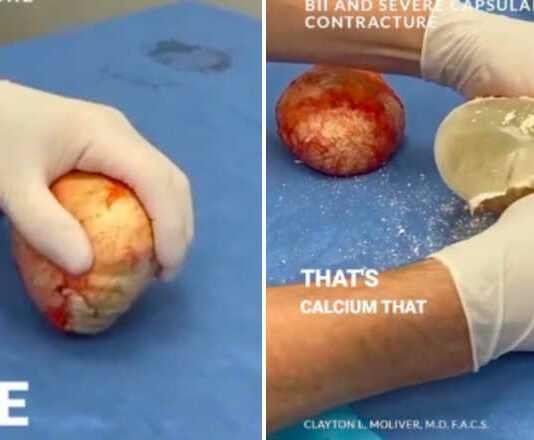 screenshots of TikTok video of doctor cracking open calcified breast implants